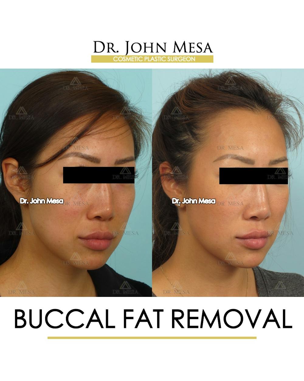 Buccal Fat Pad Removal Before & After Gallery - Patient 448531 - Image 2