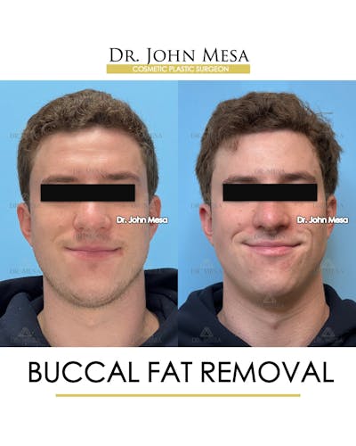 Buccal Fat Pad Removal for Men Before & After Gallery - Patient 127636 - Image 2