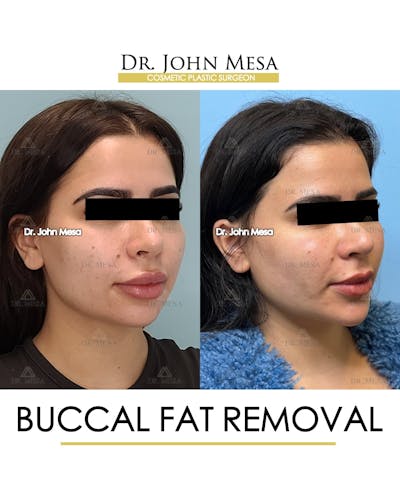Buccal Fat Pad Removal Before & After Gallery - Patient 387573 - Image 2