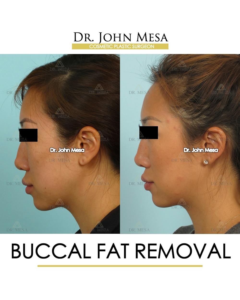 Buccal Fat Pad Removal Before & After Gallery - Patient 448531 - Image 5