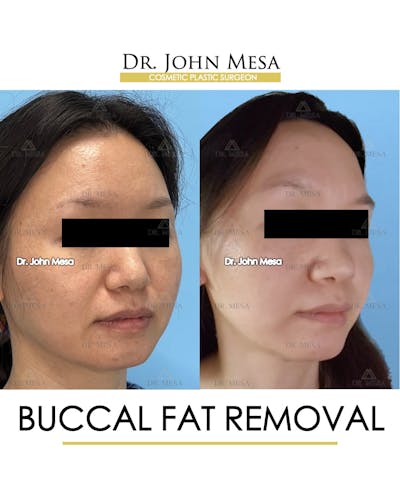 Buccal Fat Pad Removal Before & After Gallery - Patient 302040 - Image 2