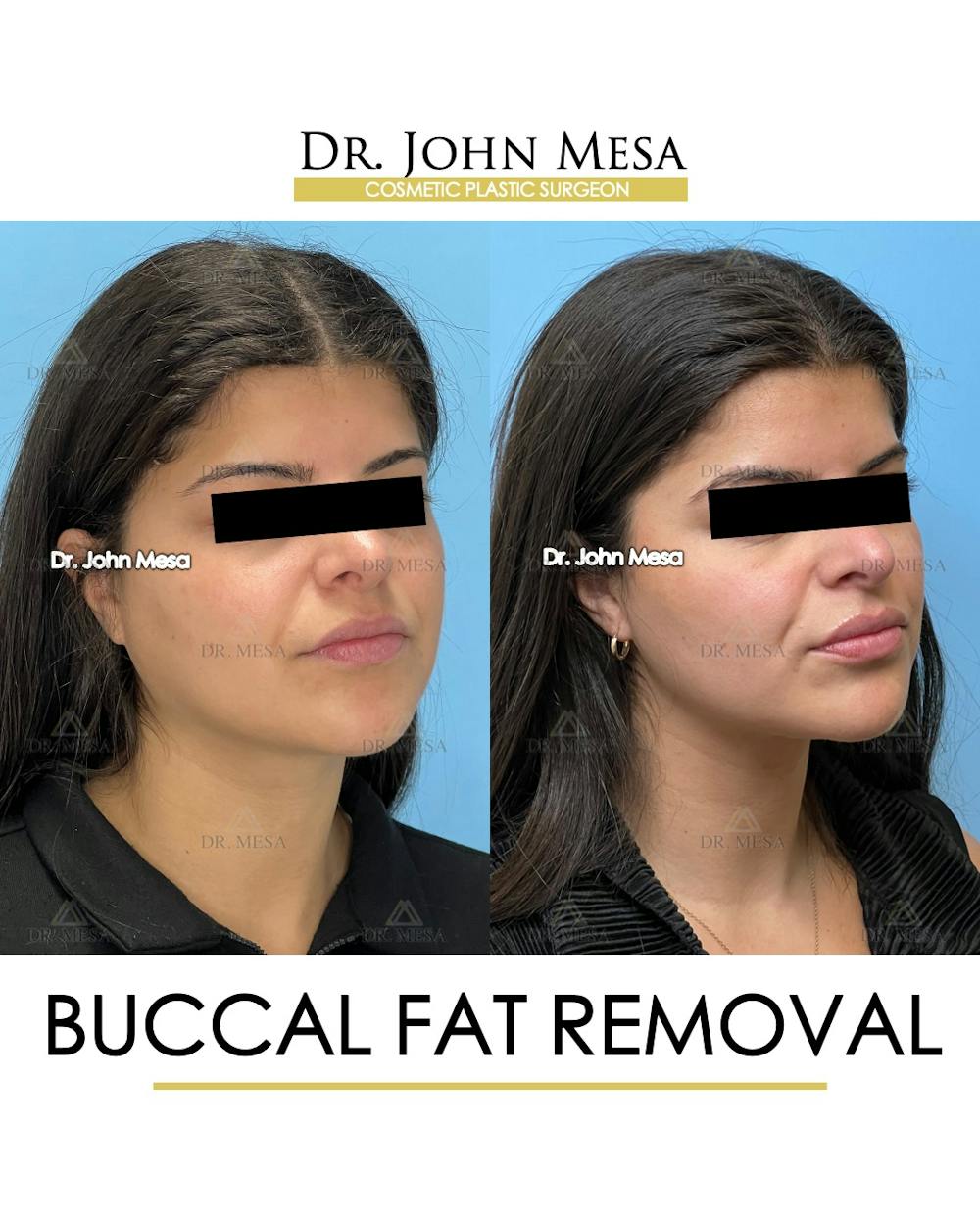 Buccal Fat Pad Removal Before & After Gallery - Patient 165538 - Image 3