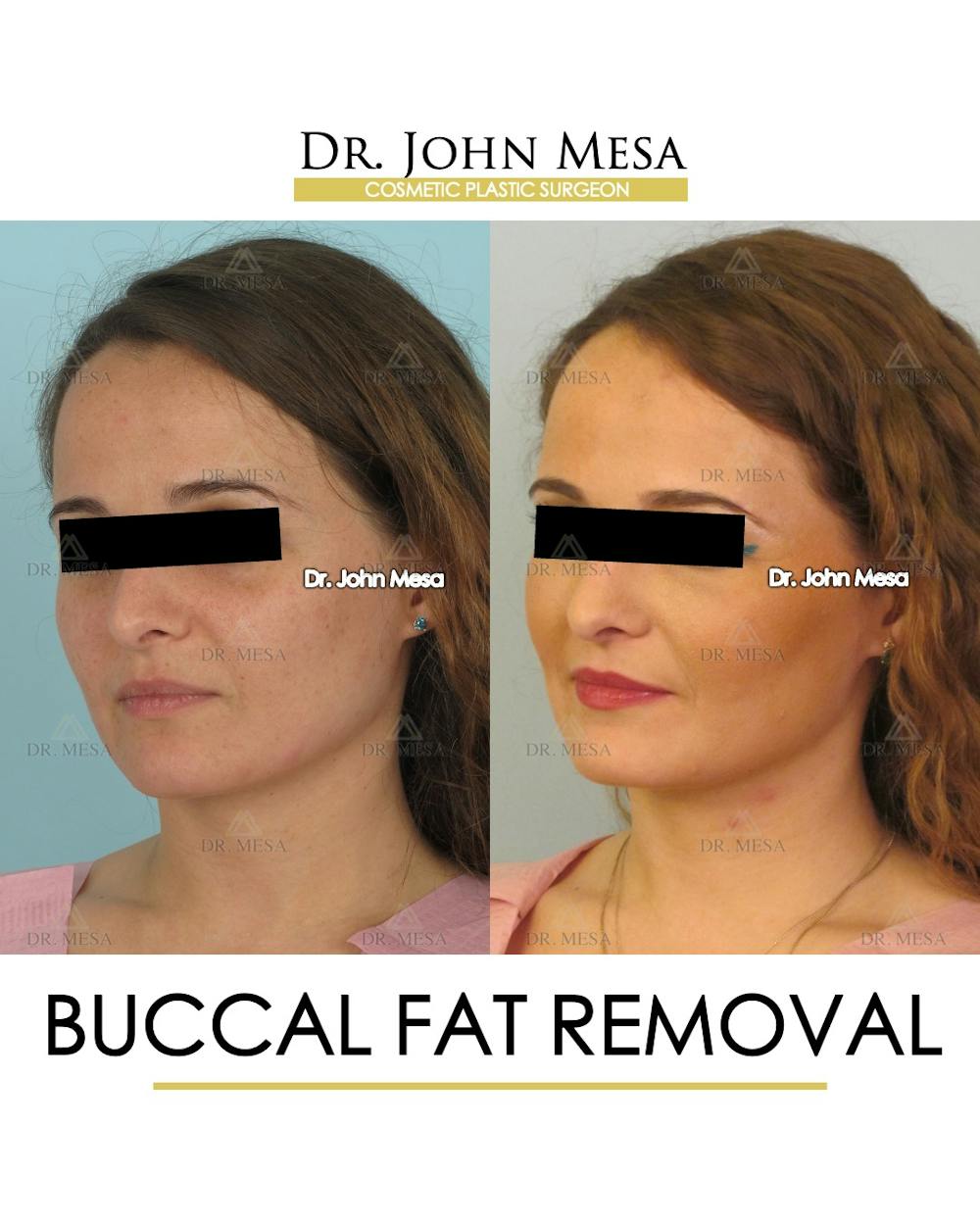 Buccal Fat Pad Removal Before & After Gallery - Patient 323232 - Image 4