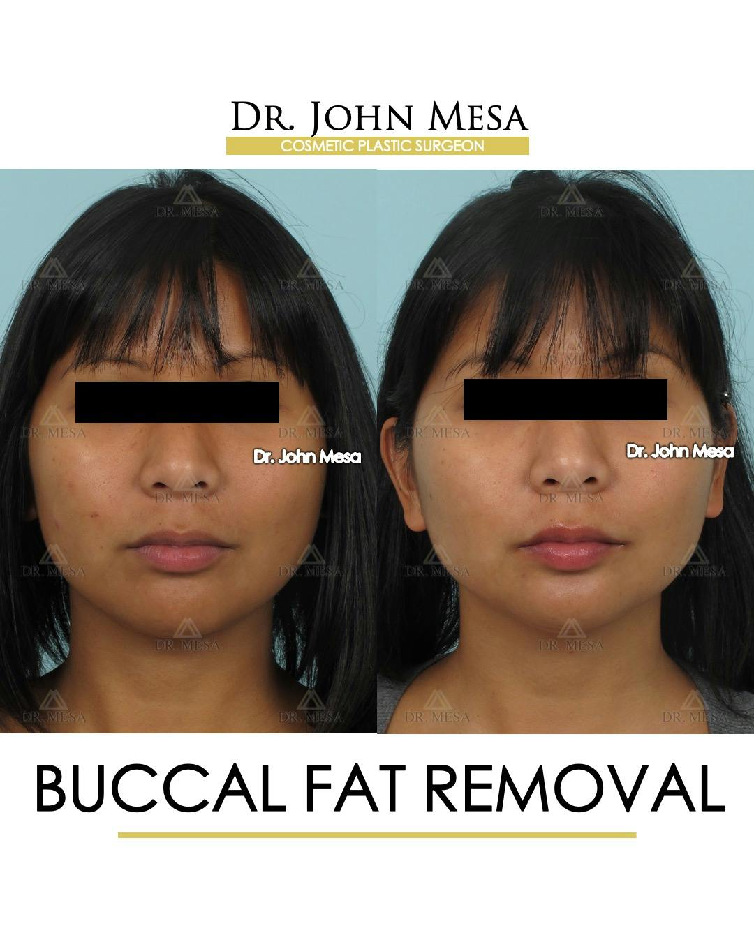 Buccal Fat Pad Removal Before & After Gallery - Patient 793933 - Image 1