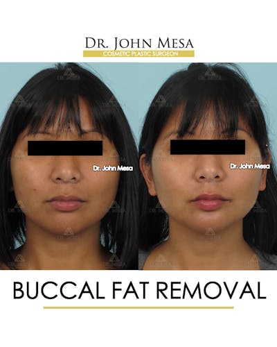 Buccal Fat Pad Removal Before & After Gallery - Patient 793933 - Image 1