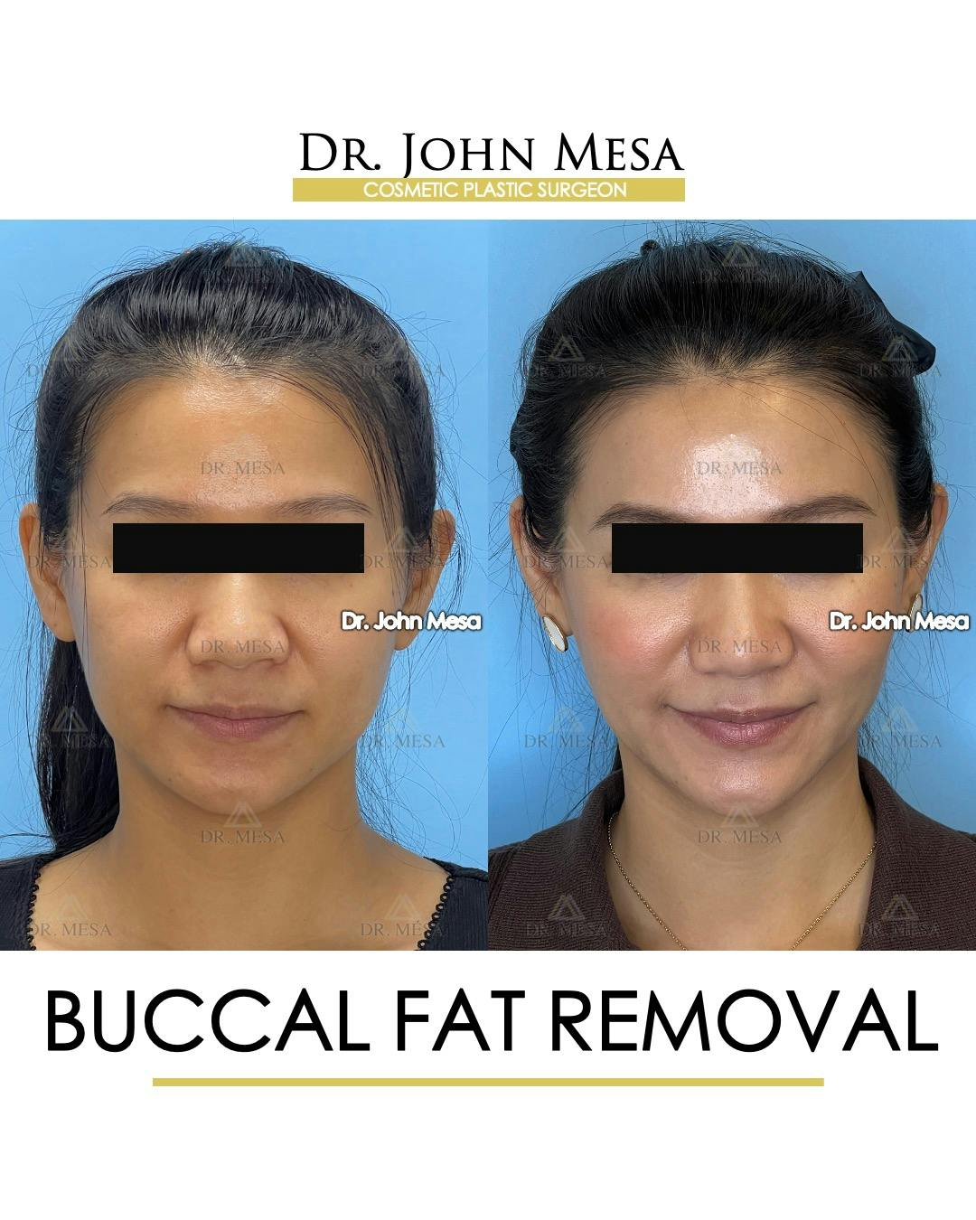 Buccal Fat Pad Removal Before & After Gallery - Patient 278613 - Image 1