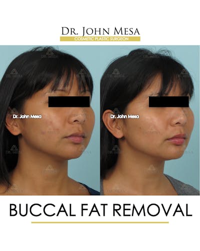 Buccal Fat Pad Removal Before & After Gallery - Patient 793933 - Image 2