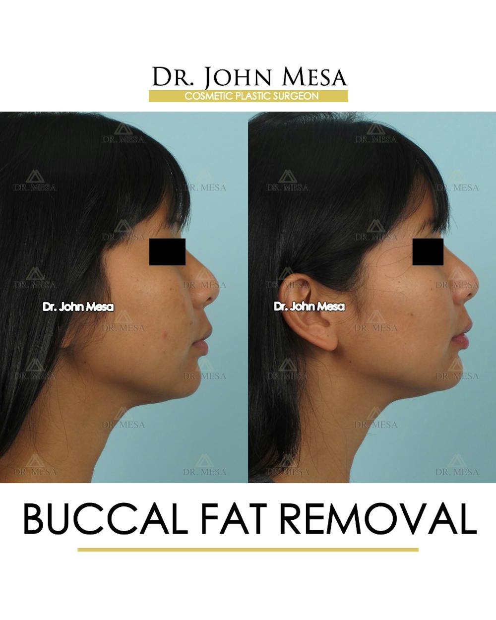 Buccal Fat Pad Removal Before & After Gallery - Patient 793933 - Image 3