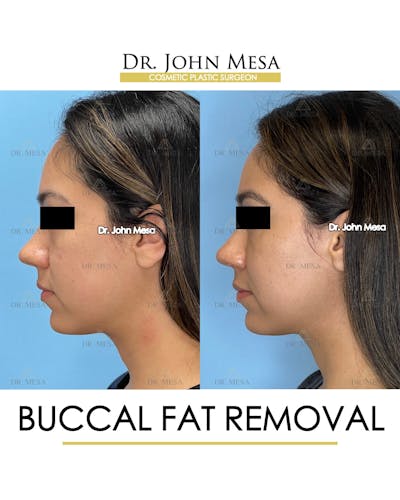 Buccal Fat Pad Removal Before & After Gallery - Patient 262137 - Image 6