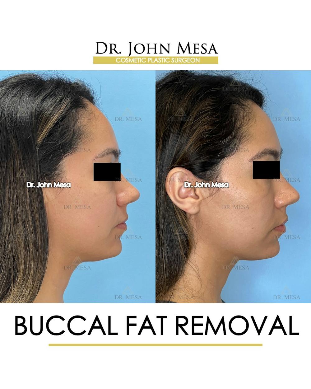 Buccal Fat Pad Removal Before & After Gallery - Patient 262137 - Image 5