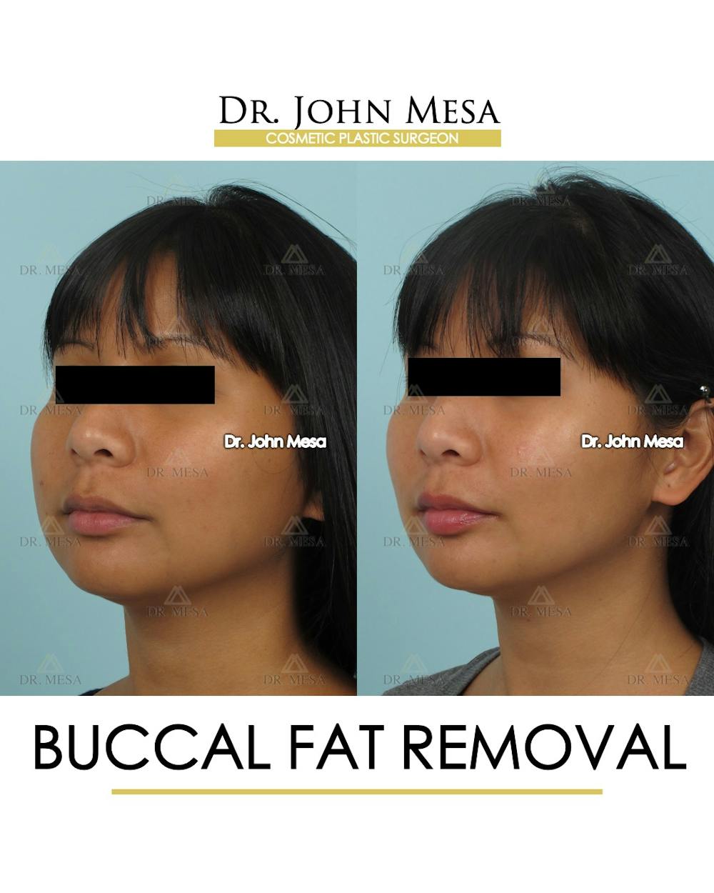 Buccal Fat Pad Removal Before & After Gallery - Patient 793933 - Image 4