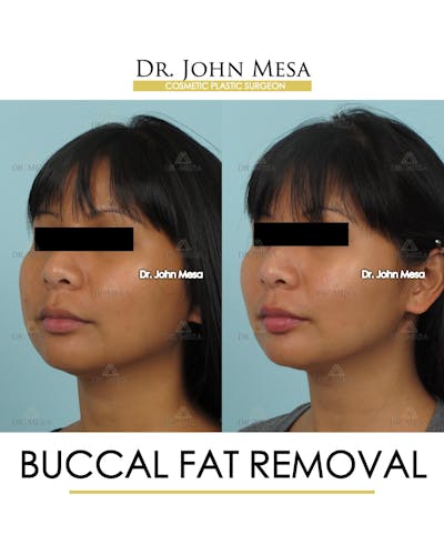 Buccal Fat Pad Removal Before & After Gallery - Patient 793933 - Image 4