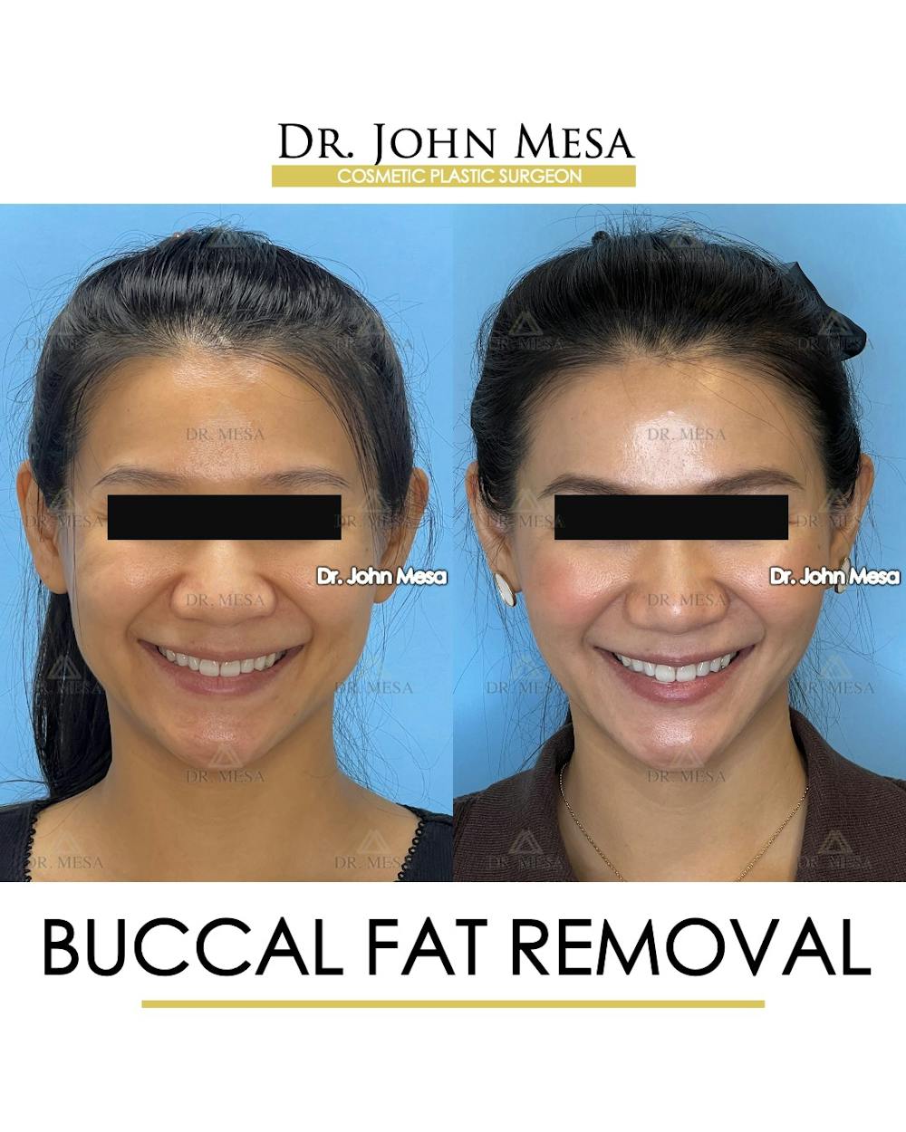 Buccal Fat Pad Removal Before & After Gallery - Patient 278613 - Image 2