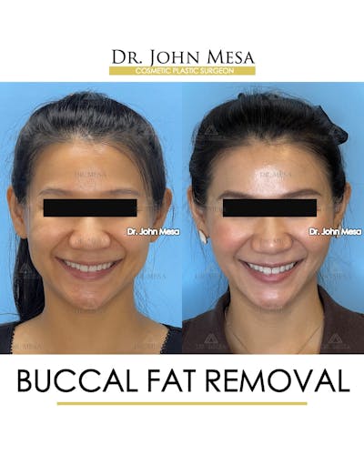 Buccal Fat Pad Removal Before & After Gallery - Patient 278613 - Image 2