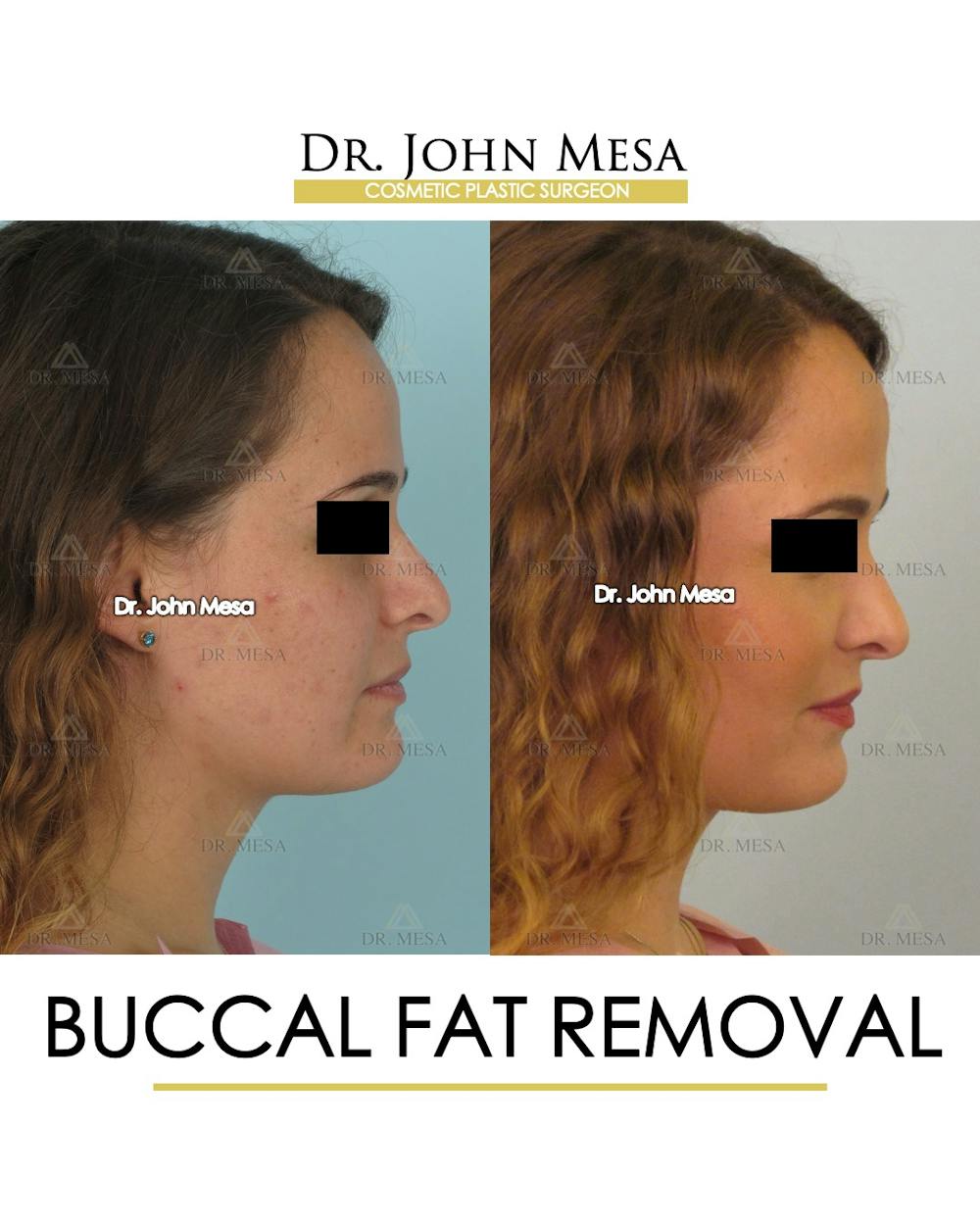 Buccal Fat Pad Removal Before & After Gallery - Patient 323232 - Image 3