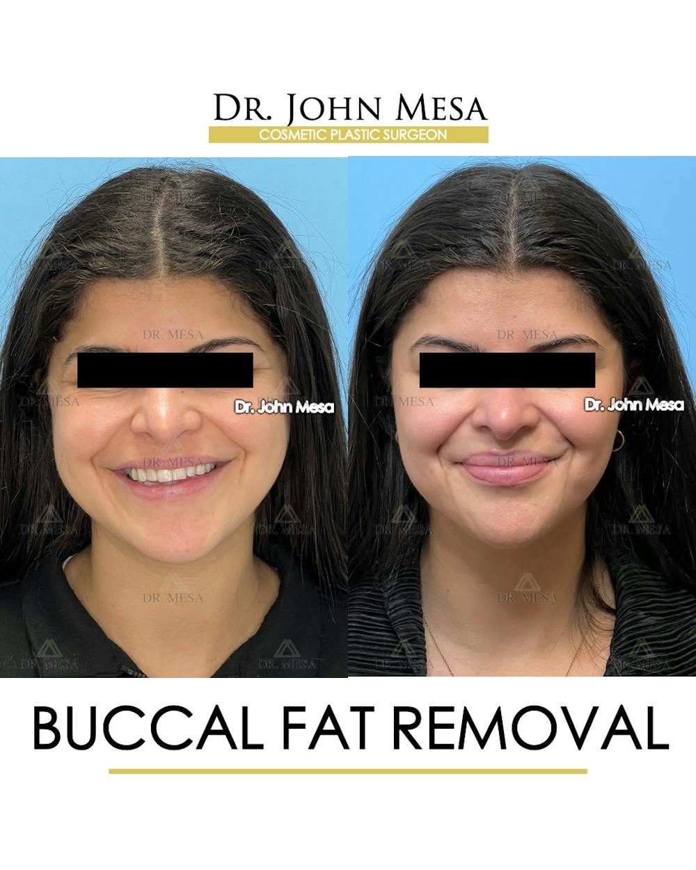 Buccal Fat Pad Removal Before & After Gallery - Patient 165538 - Image 2