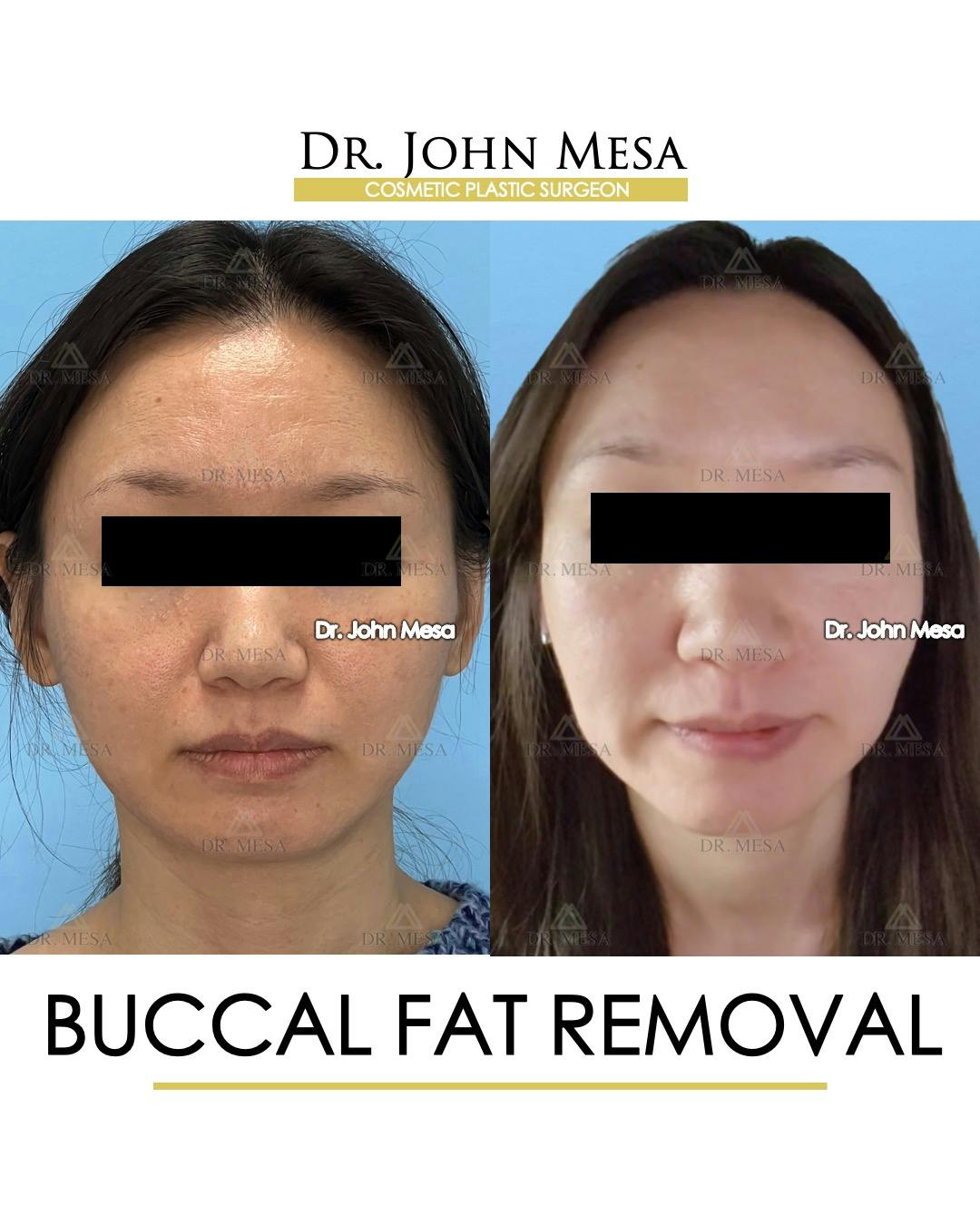 Buccal Fat Pad Removal Before & After Gallery - Patient 302040 - Image 1