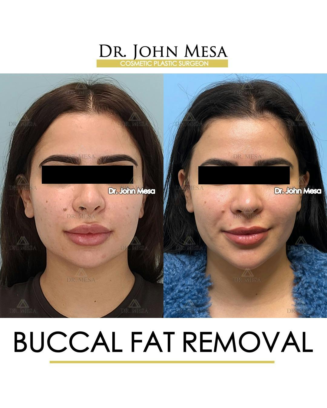 Buccal Fat Pad Removal Before & After Gallery - Patient 387573 - Image 1