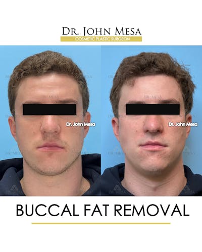 Buccal Fat Pad Removal for Men Before & After Gallery - Patient 127636 - Image 1