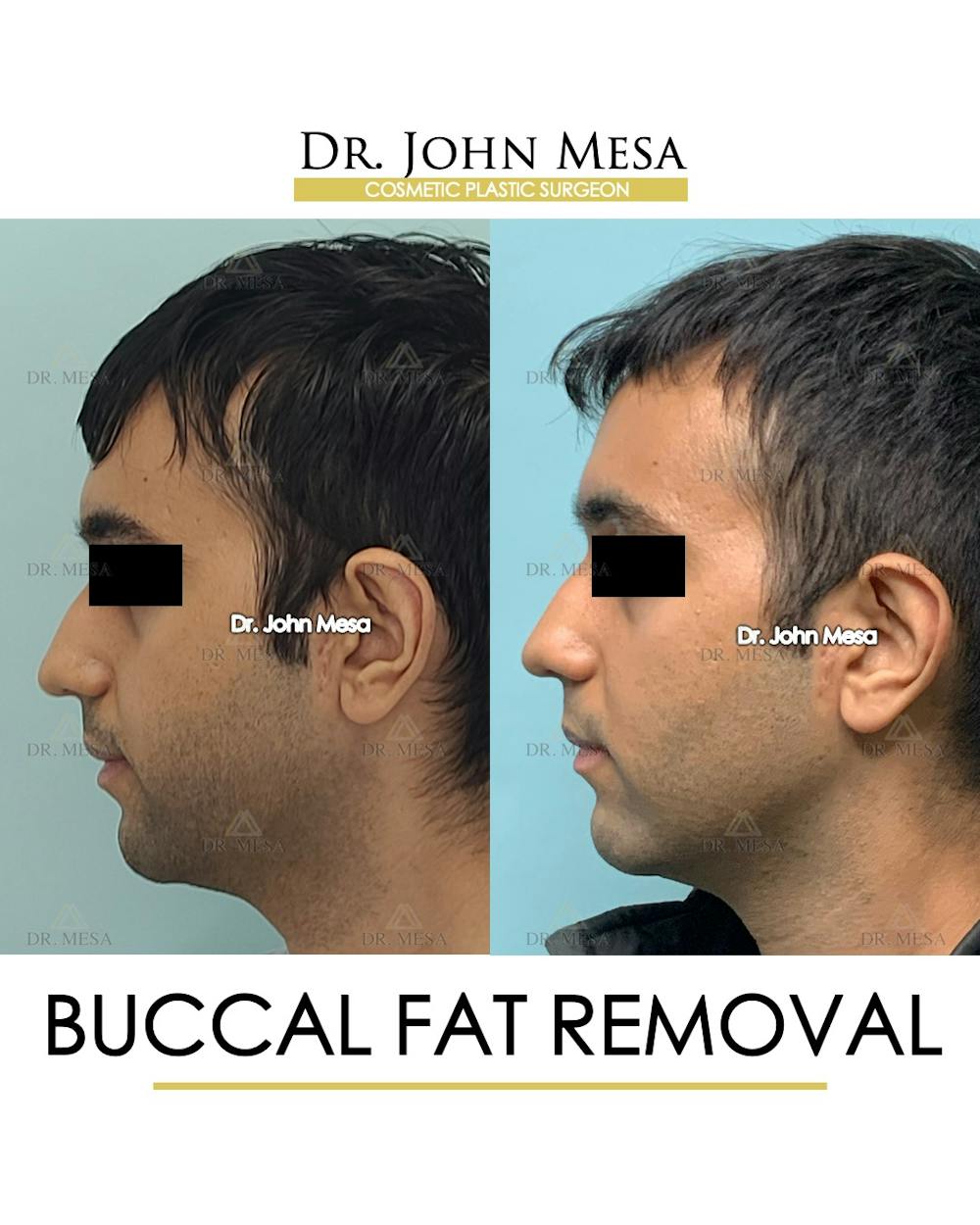 Buccal Fat Pad Removal for Men Before & After Gallery - Patient 245296 - Image 5