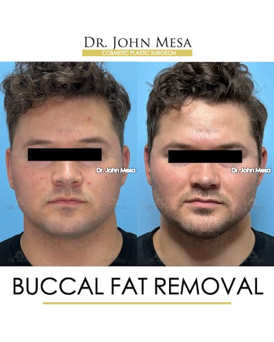 Buccal Fat Pad Removal for Men Before & After Gallery - Patient 185020 - Image 1