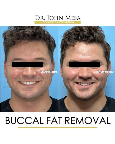 Buccal Fat Pad Removal for Men Before & After Gallery - Patient 185020 - Image 2