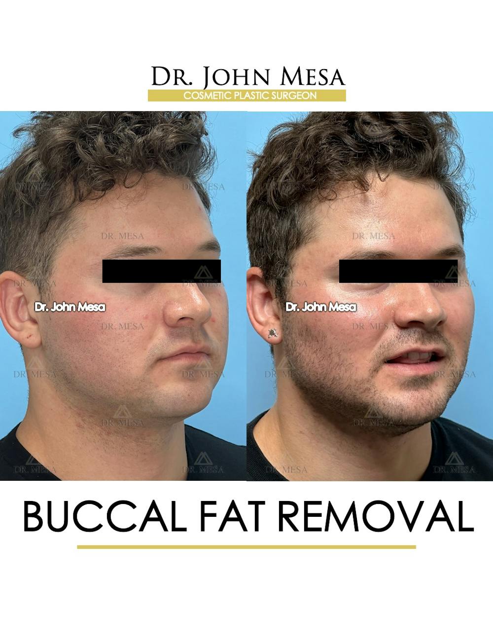Buccal Fat Pad Removal for Men Before & After Gallery - Patient 185020 - Image 3