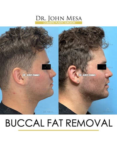 Buccal Fat Pad Removal for Men Before & After Gallery - Patient 185020 - Image 4