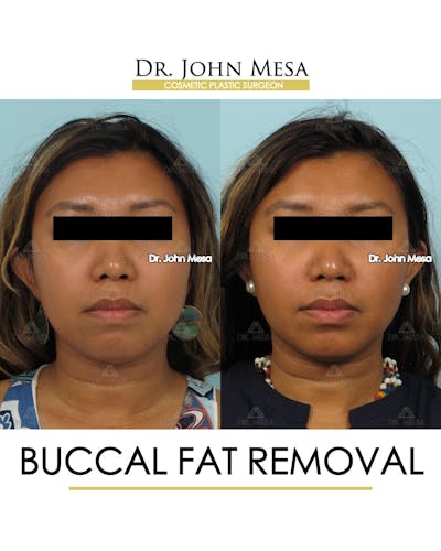 Buccal Fat Pad Removal Before & After Gallery - Patient 388739 - Image 1