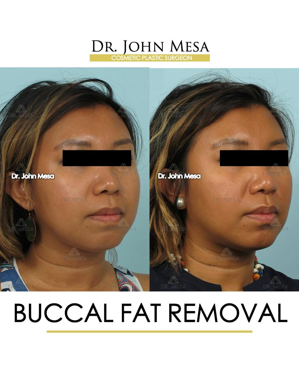 Buccal Fat Pad Removal Before & After Gallery - Patient 388739 - Image 3