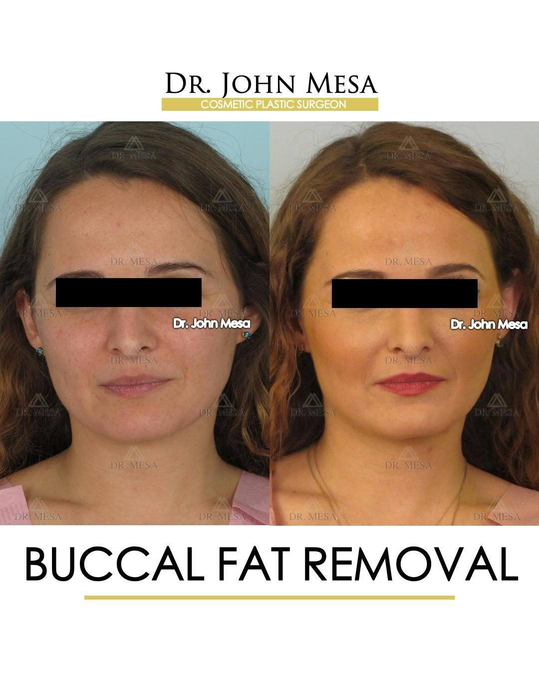 Buccal Fat Pad Removal Before & After Gallery - Patient 323232 - Image 1