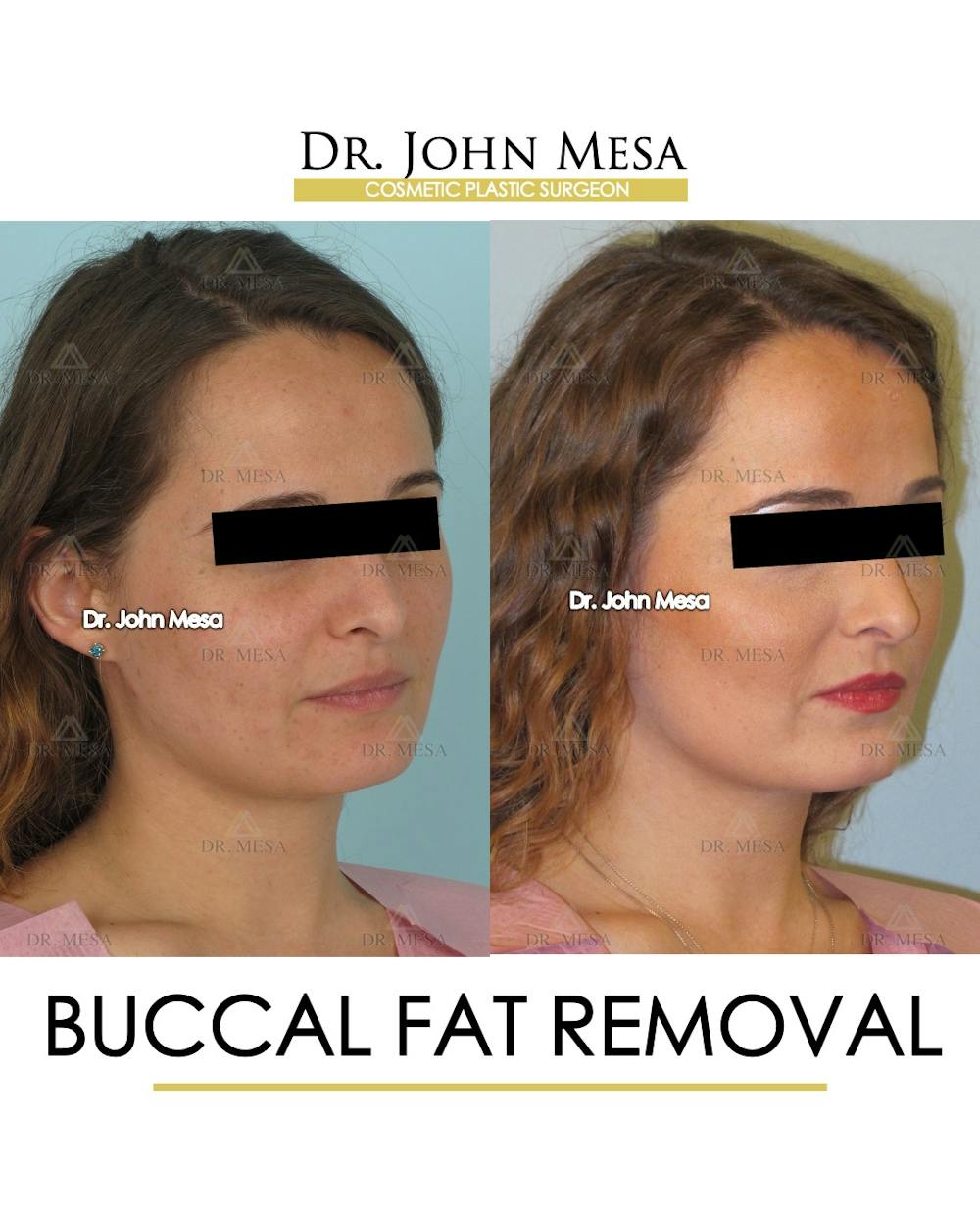 Buccal Fat Pad Removal Before & After Gallery - Patient 323232 - Image 2
