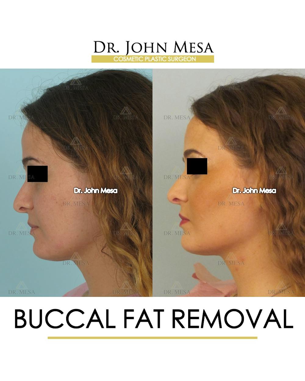 Buccal Fat Pad Removal Before & After Gallery - Patient 323232 - Image 5