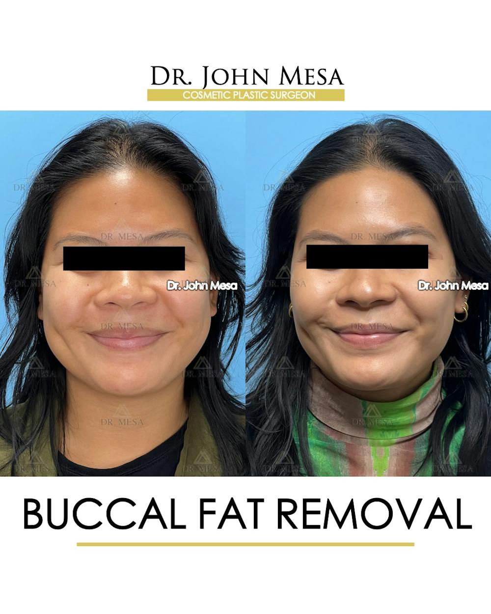 Buccal Fat Pad Removal Before & After Gallery - Patient 392039 - Image 2