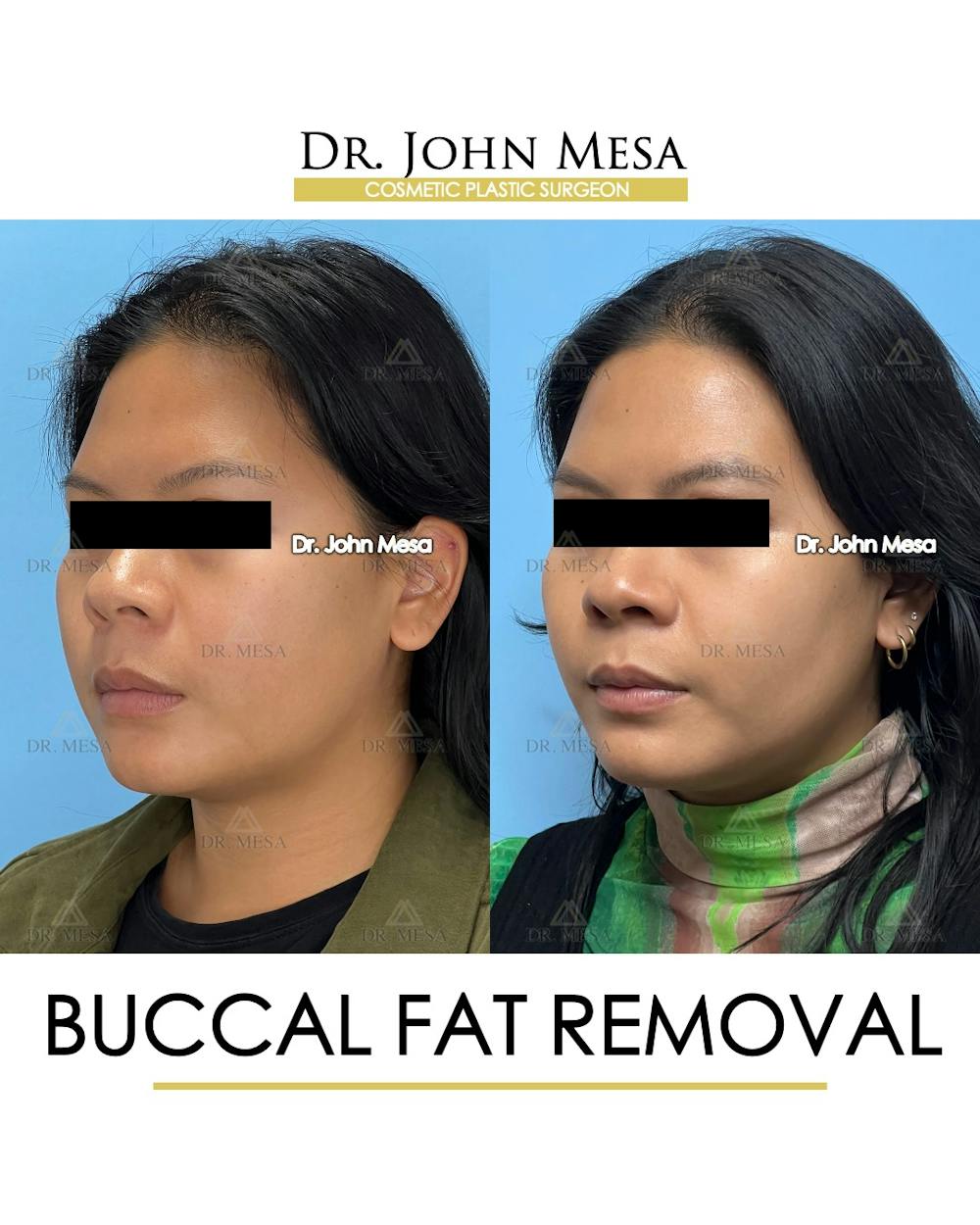 Buccal Fat Pad Removal Before & After Gallery - Patient 392039 - Image 5