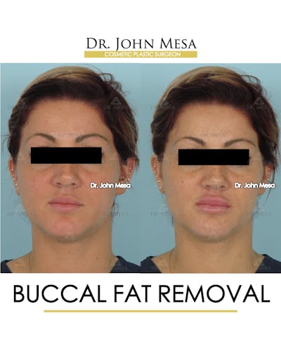 Buccal Fat Pad Removal Before & After Gallery - Patient 234336 - Image 1