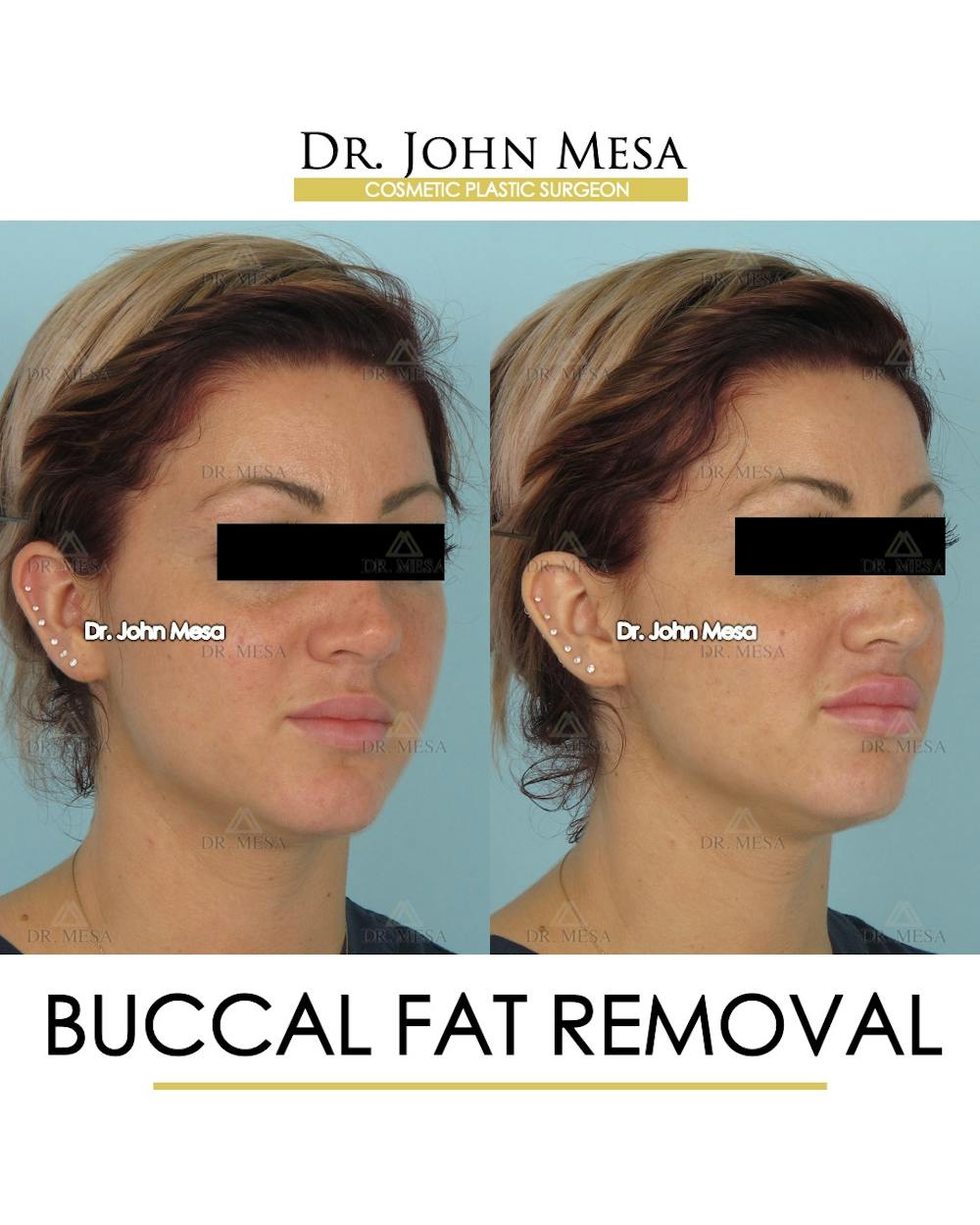 Buccal Fat Pad Removal Before & After Gallery - Patient 234336 - Image 2