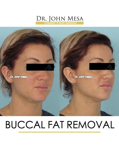 Buccal Fat Pad Removal Before & After Gallery - Patient 234336 - Image 2