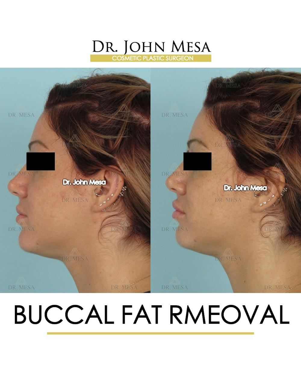 Buccal Fat Pad Removal Before & After Gallery - Patient 234336 - Image 5