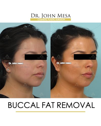 Buccal Fat Pad Removal Before & After Gallery - Patient 120998 - Image 2