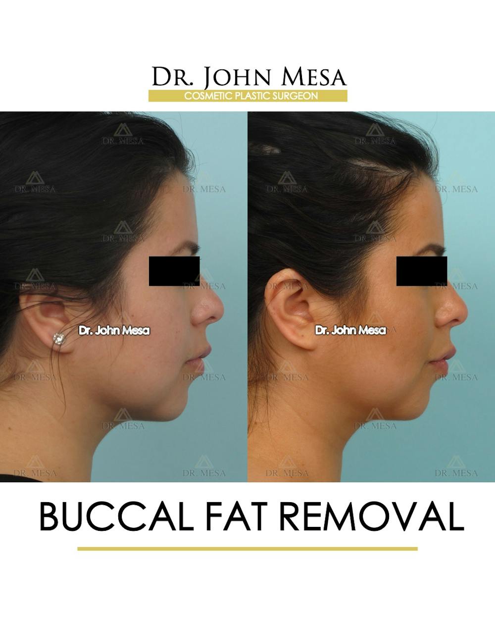 Buccal Fat Pad Removal Before & After Gallery - Patient 120998 - Image 3