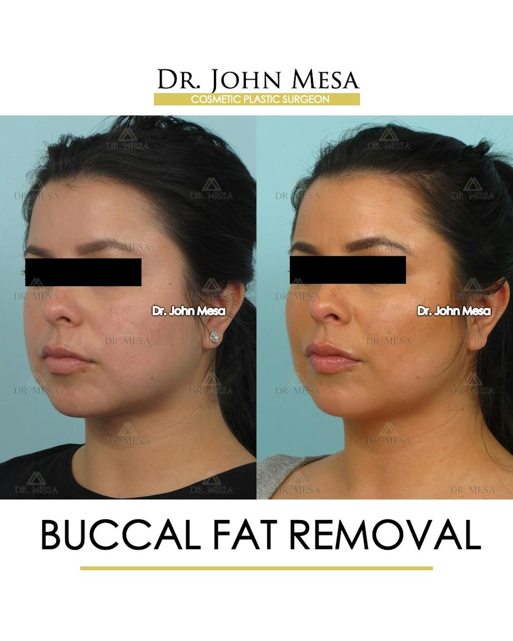 Buccal Fat Pad Removal Before & After Gallery - Patient 120998 - Image 4