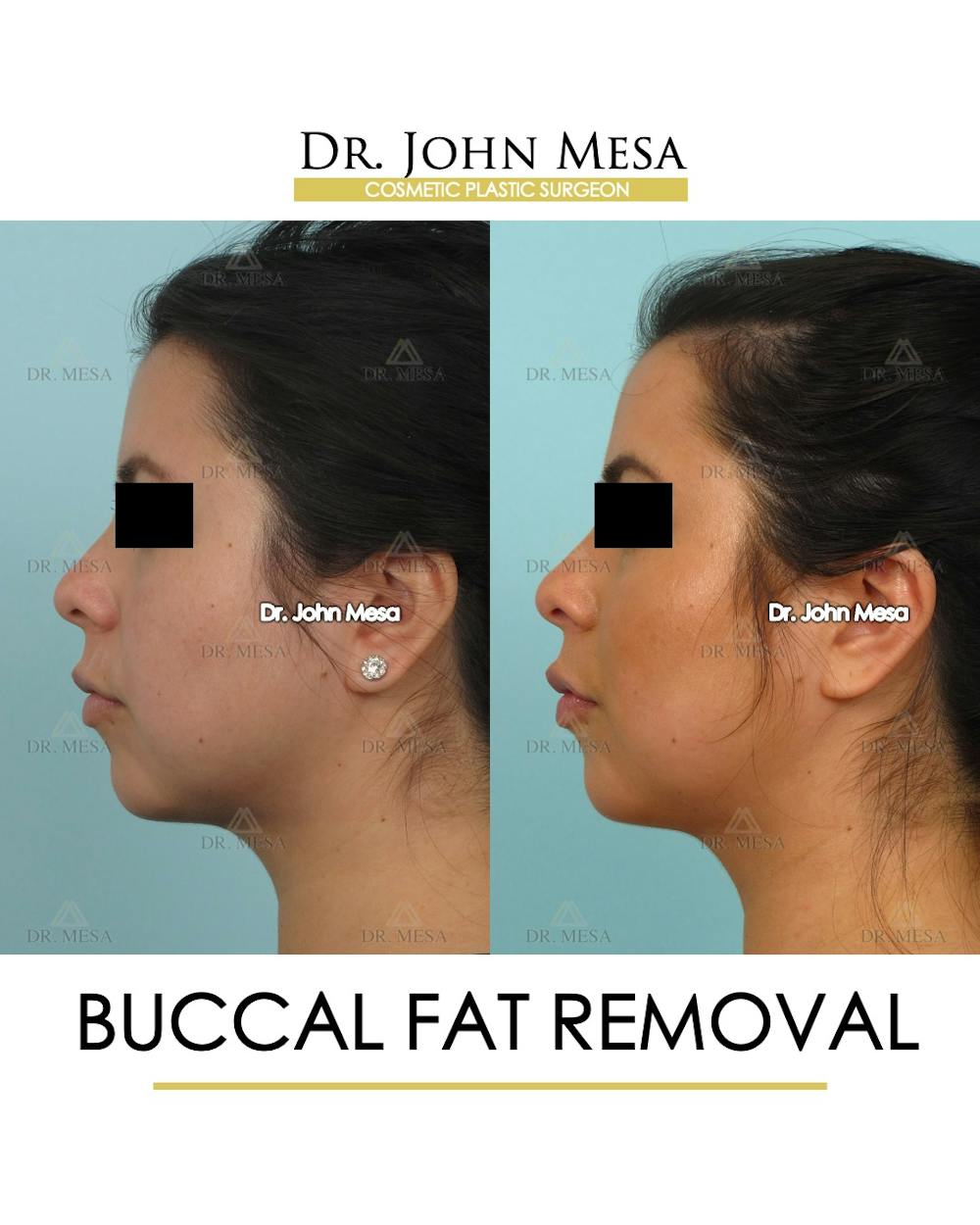 Buccal Fat Pad Removal Before & After Gallery - Patient 120998 - Image 5