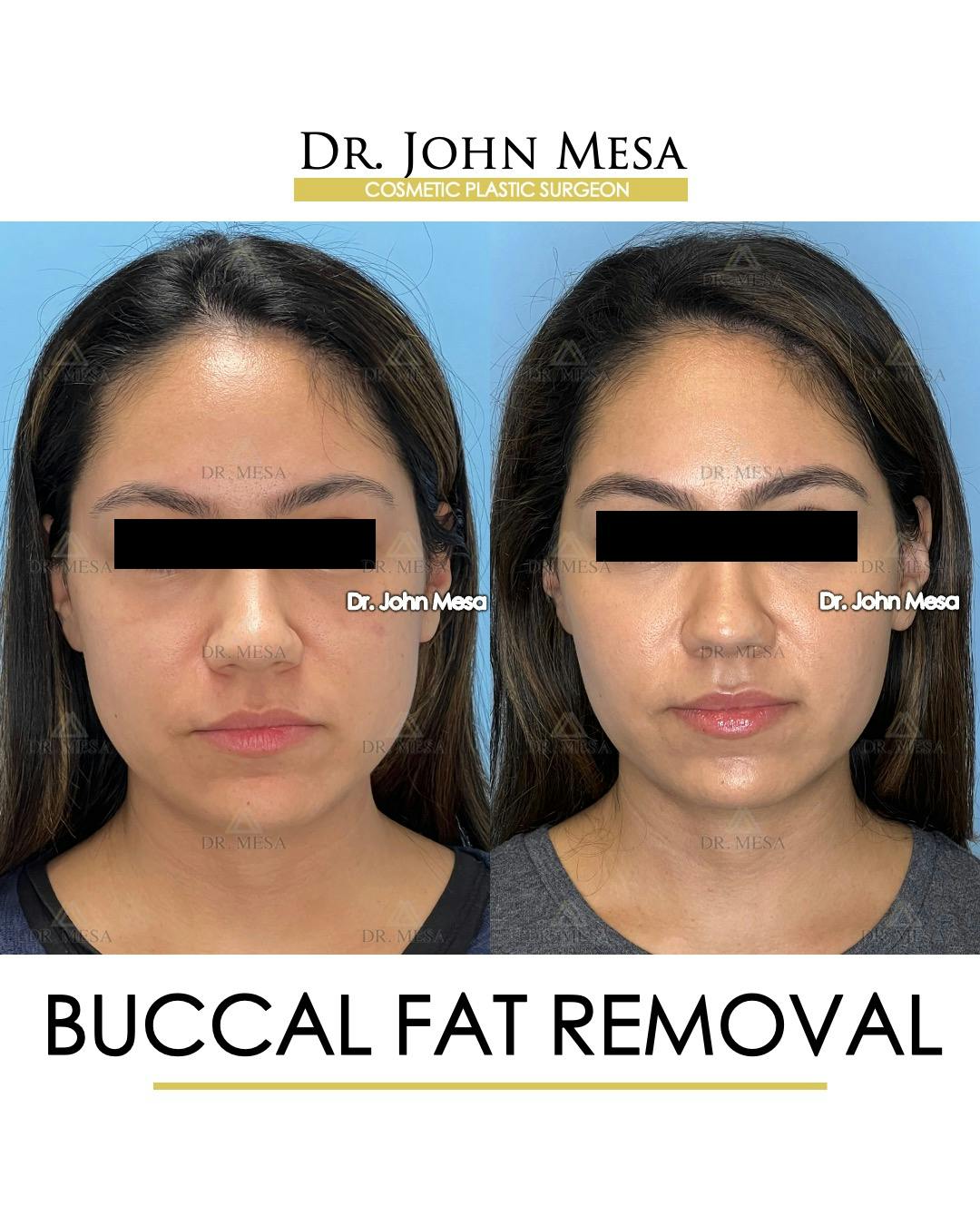 Buccal Fat Pad Removal Before & After Gallery - Patient 262137 - Image 1
