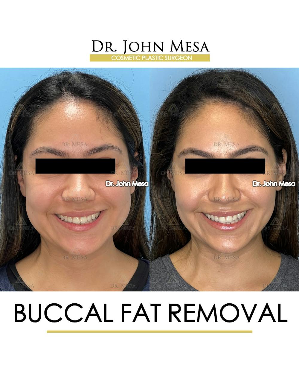 Buccal Fat Pad Removal Before & After Gallery - Patient 262137 - Image 2