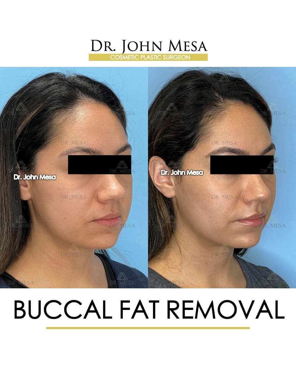 Buccal Fat Pad Removal Before & After Gallery - Patient 262137 - Image 3