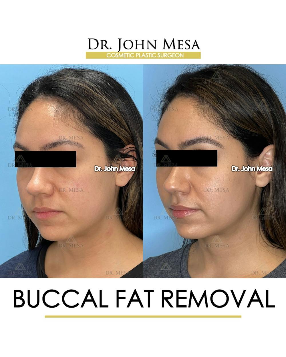 Buccal Fat Pad Removal Before & After Gallery - Patient 262137 - Image 4