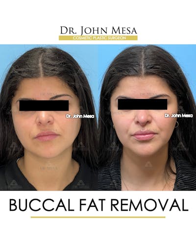 Buccal Fat Pad Removal Before & After Gallery - Patient 165538 - Image 1