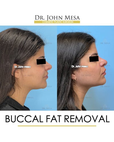 Buccal Fat Pad Removal Before & After Gallery - Patient 165538 - Image 4
