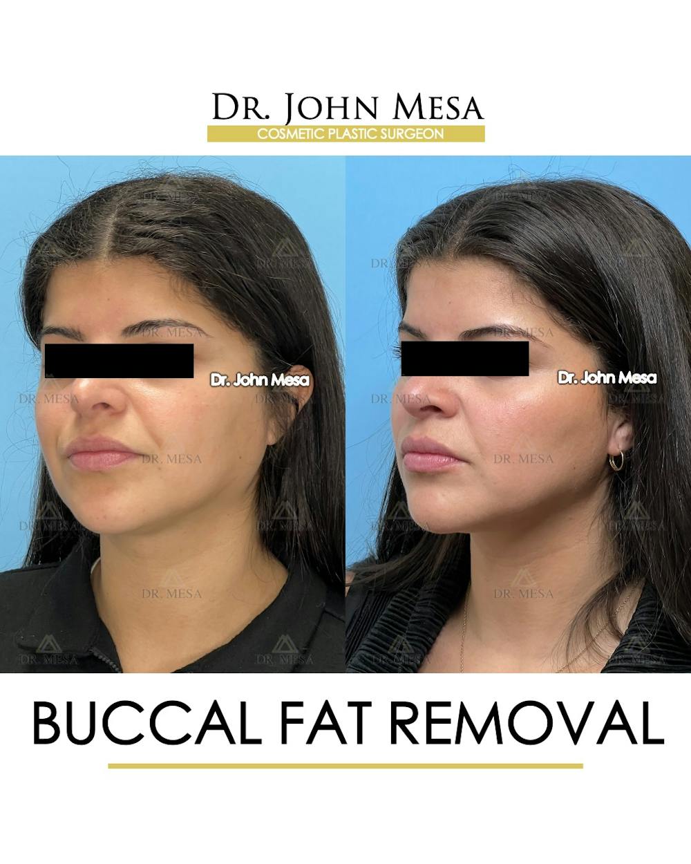Buccal Fat Pad Removal Before & After Gallery - Patient 165538 - Image 5